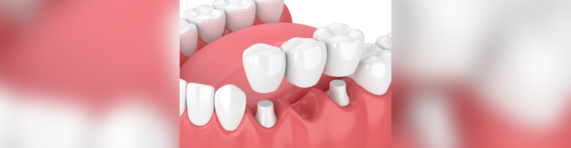 Dental Bridges