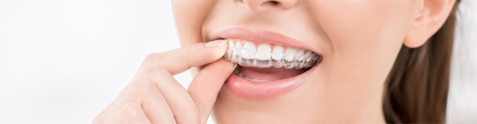 Clear Braces