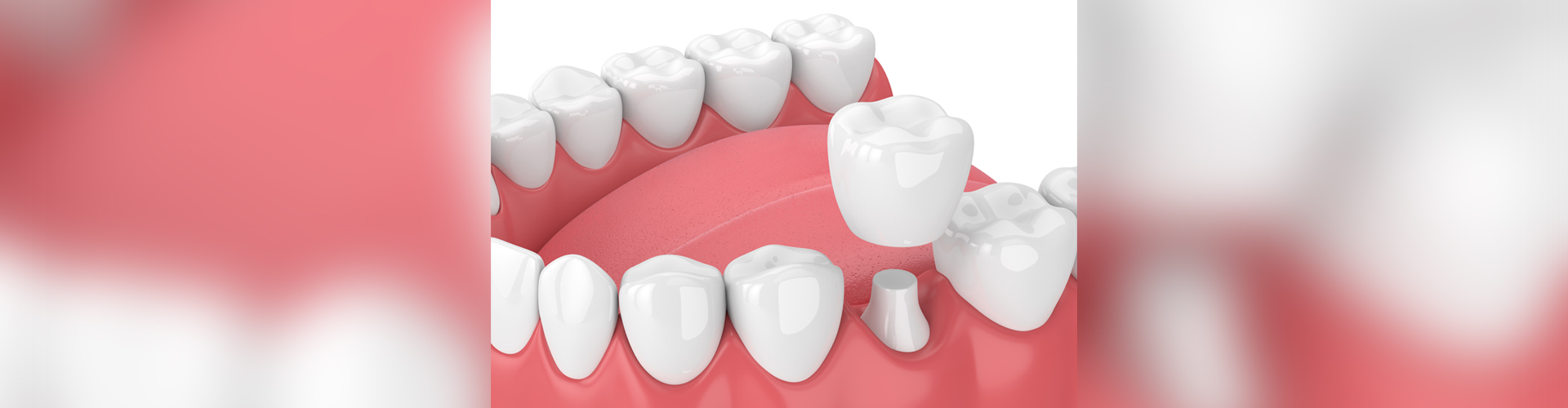 Dental Crowns