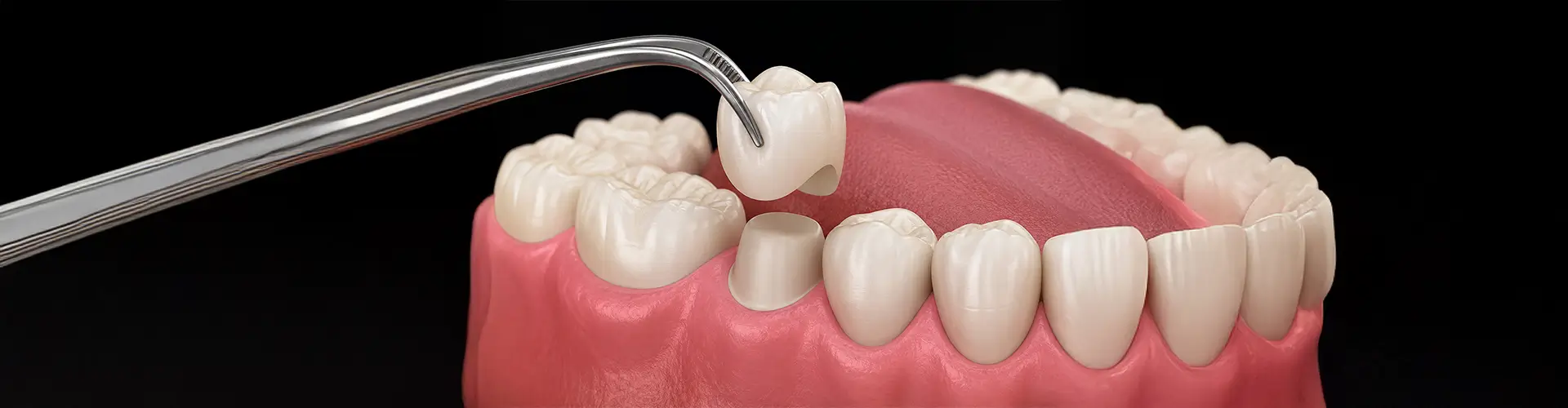 Dental Crowns