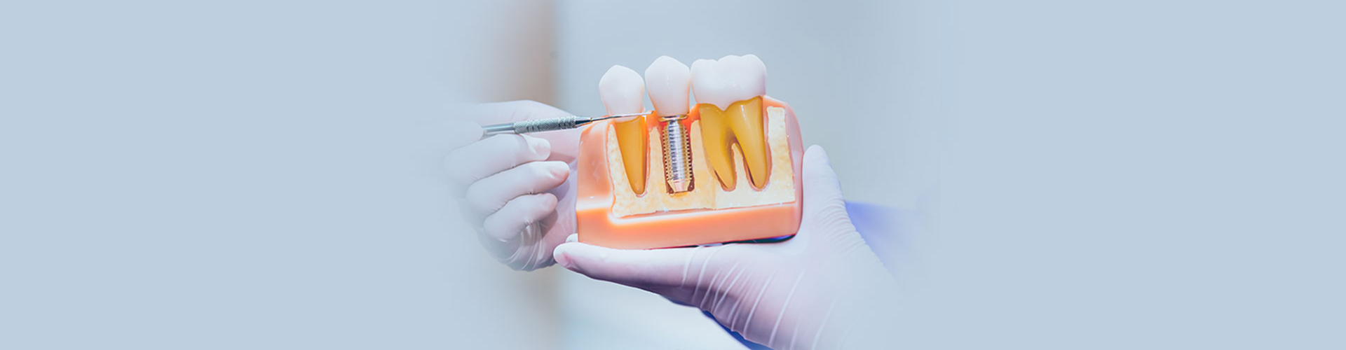 Dental Implants