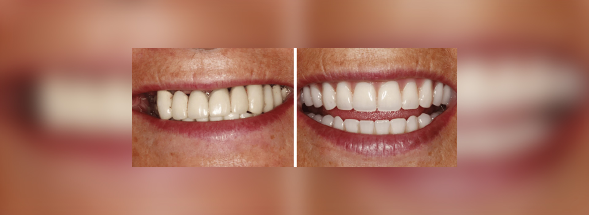 Full Mouth Restoration