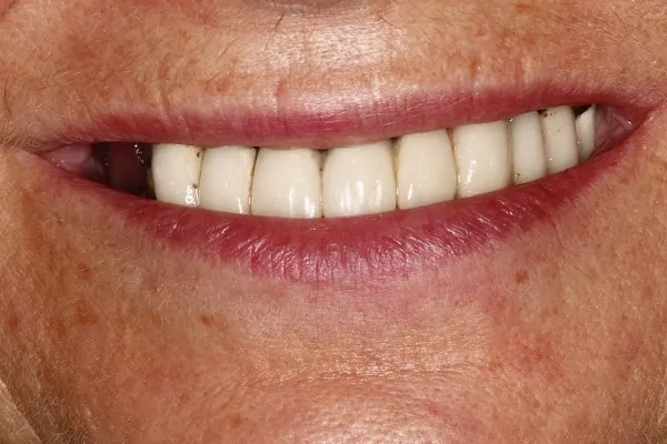 Implant Denture Before