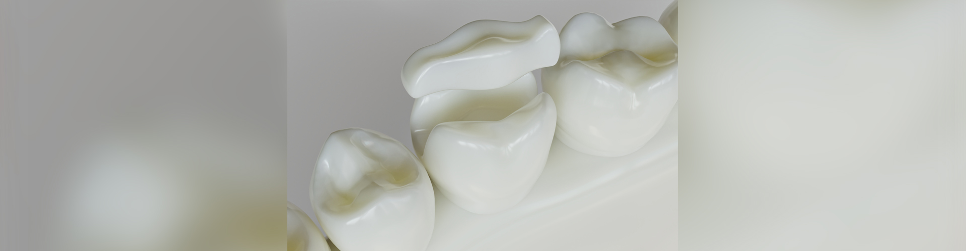 Porcelain Dental Inlays & Onlays