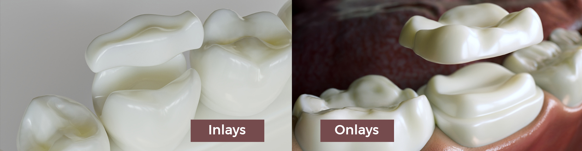 Porcelain Dental Inlays & Onlays