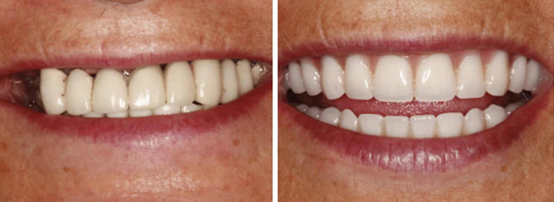 Smile Makeover