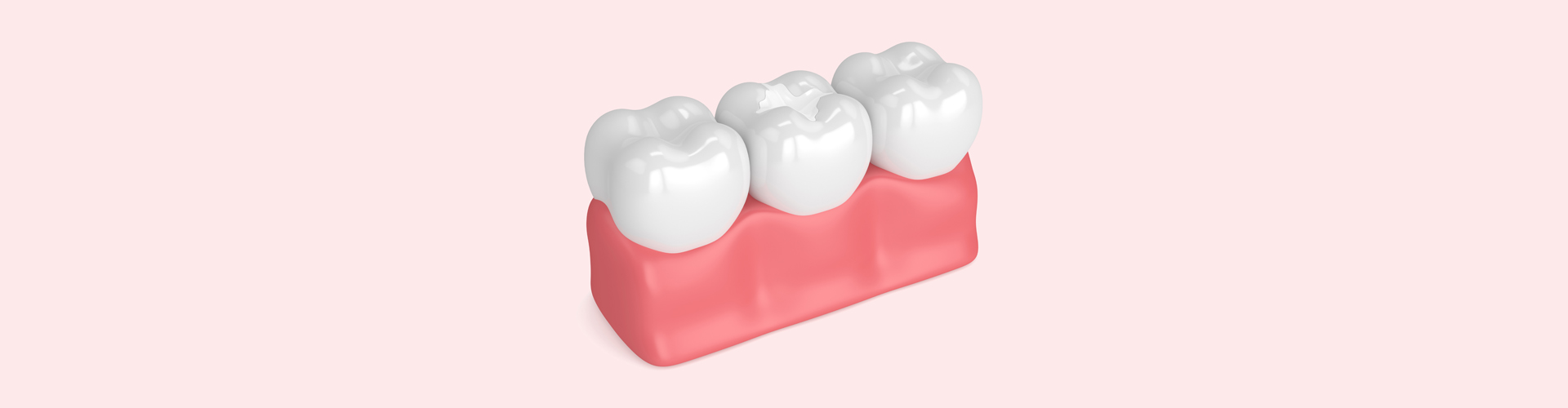 Tooth Colored Fillings
