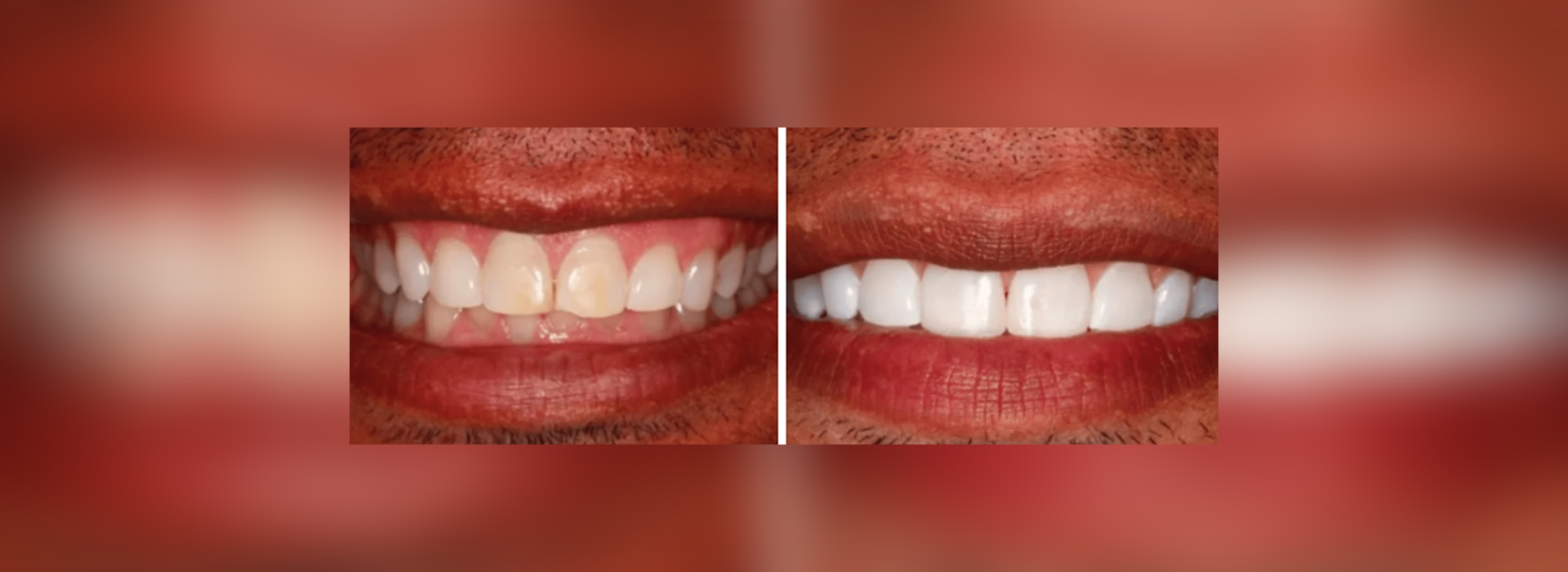 Tooth Recontouring