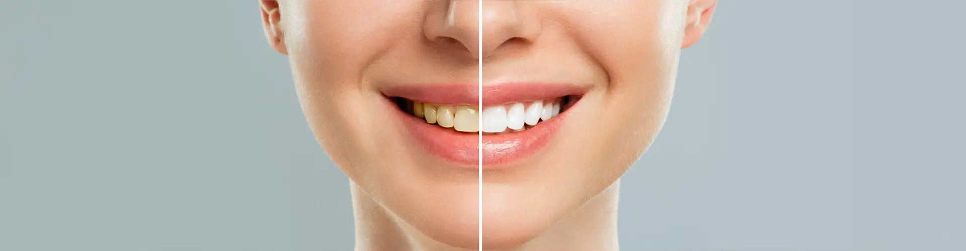 Teeth Whitening