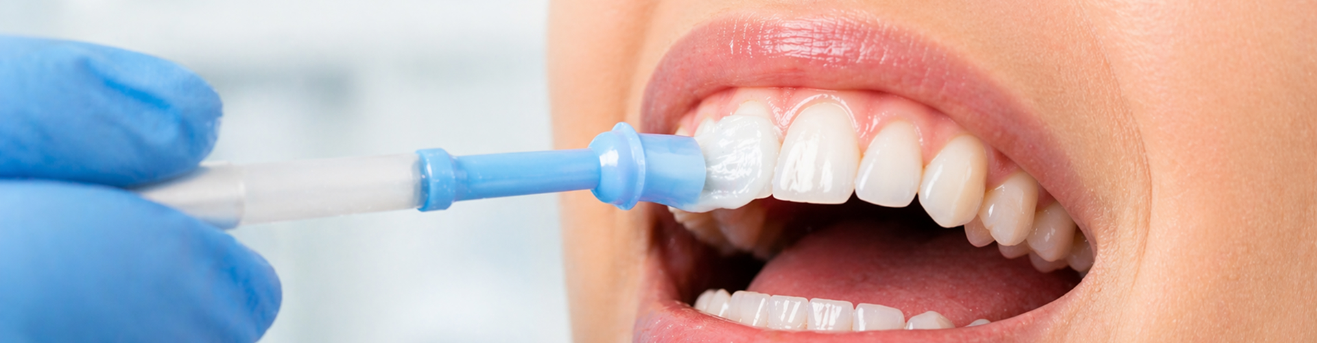 Fluoride Treatment