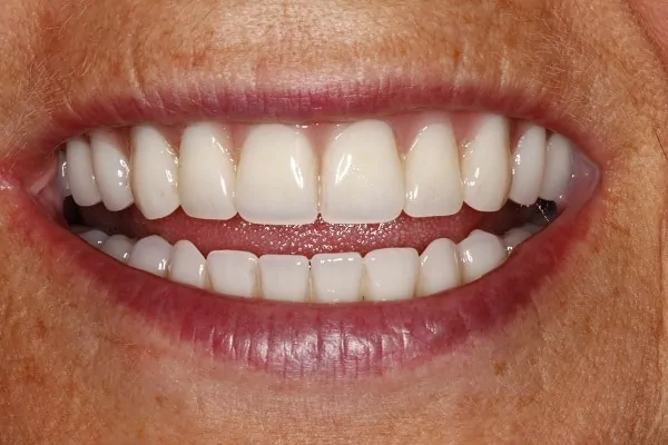 Implant Denture After
