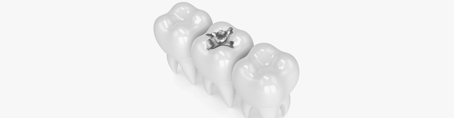 Tooth Colored Fillings