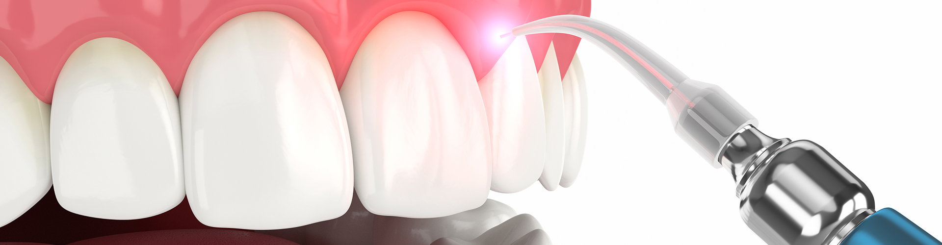 Tooth Recontouring