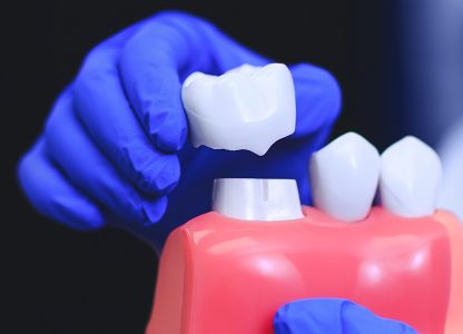 How Dental Crowns Protect Your Teeth from Further Damage and Decay