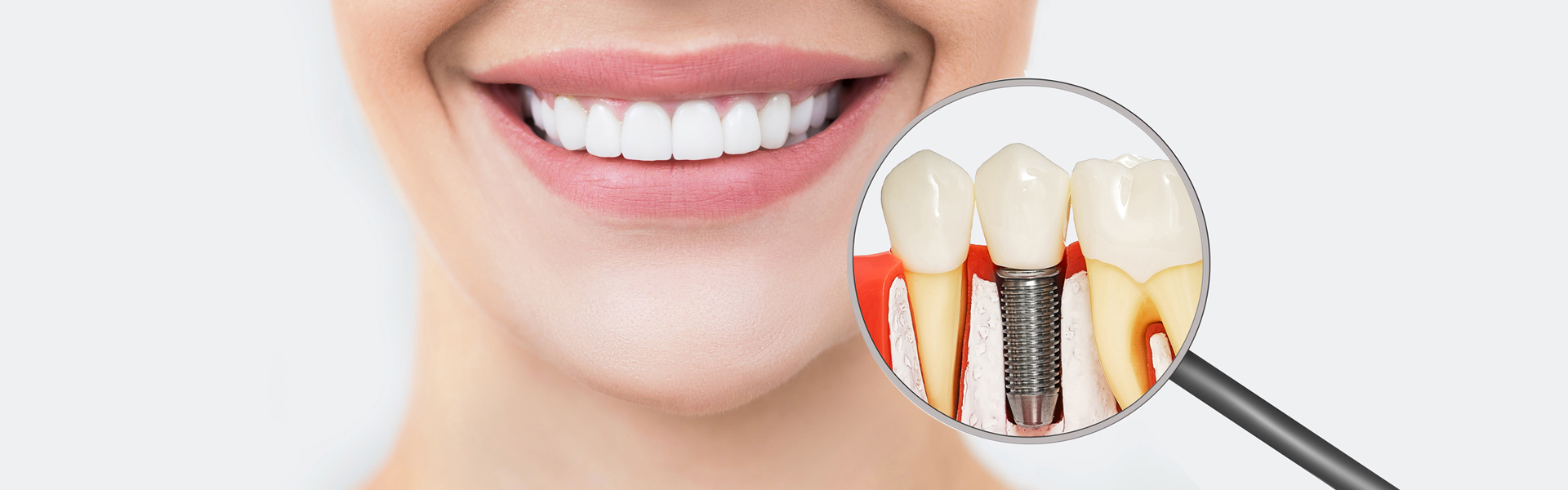 5 Signs Dental Implants Might Be the Right Choice for You