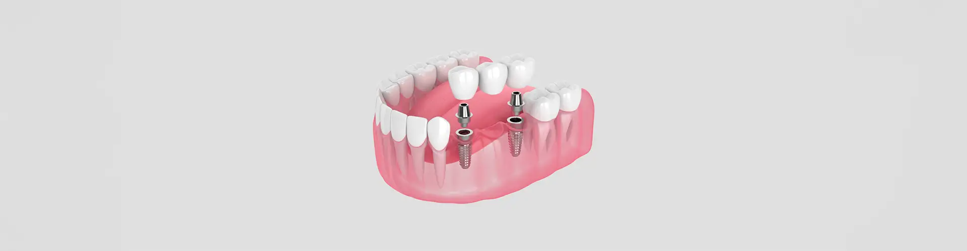 Implant Bridges