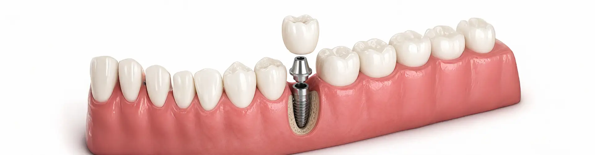 Implant Crowns