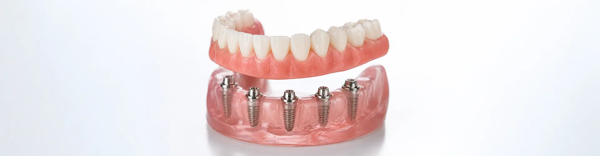 Implant Dentures