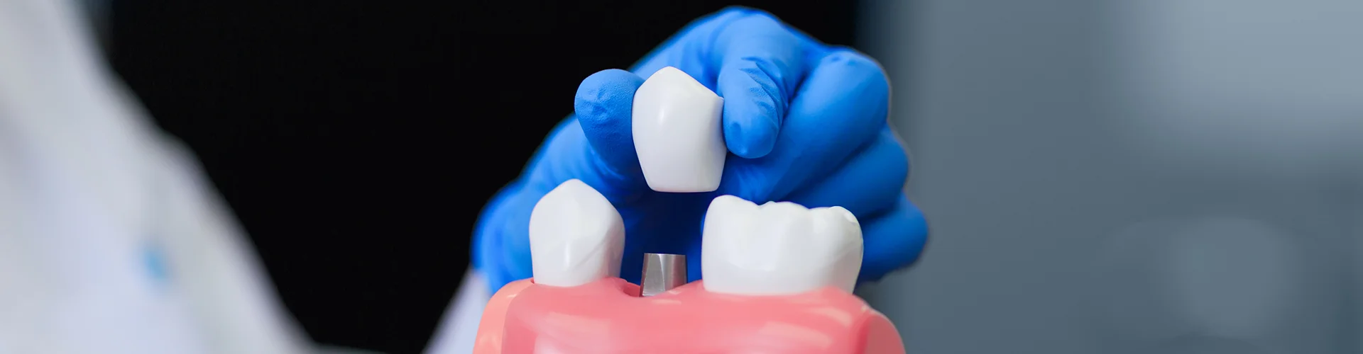 Implant Crowns